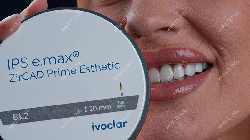 E-max Veneers